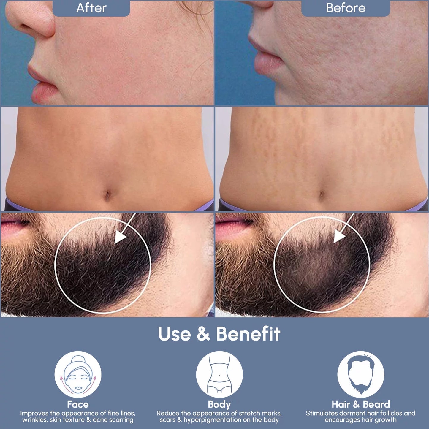 Professional Adjustable Microneedling Derma Stamp
